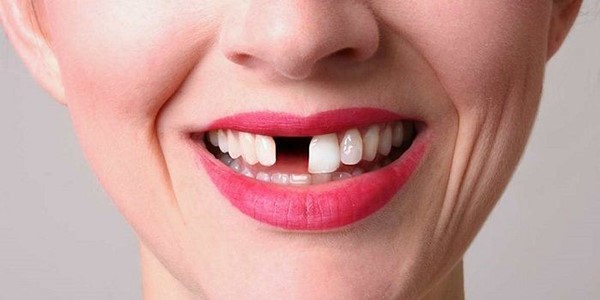 خمیر لمینت متحرک دندان